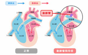 <img src="小幡緑地どうぶつ病院様_犬の動脈管開存症（PDA）.png" alt="犬の心臓の構造と動脈管開存症（PDA）の違いを示した図。左側は正常な血流を示し、右側は大動脈と肺動脈の間に動脈管が開存している状態を示している。" />