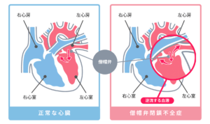 <img src="画像URL" alt="犬の正常な心臓と僧帽弁閉鎖不全症の比較図。左側に正常な僧帽弁の血液の流れ、右側に僧帽弁がうまく閉じず左心房へ血液が逆流している様子が示されている。右心房・右心室・左心房・左心室の位置関係が分かりやすく表示され、僧帽弁閉鎖不全症の特徴である逆流が強調されている図。" />
